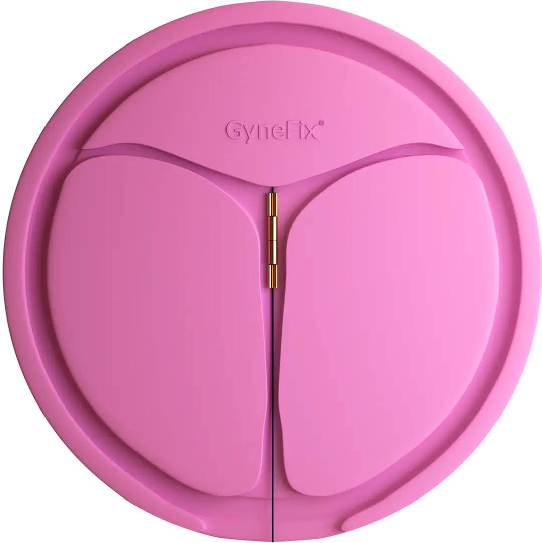 picture of gynefix in uterus