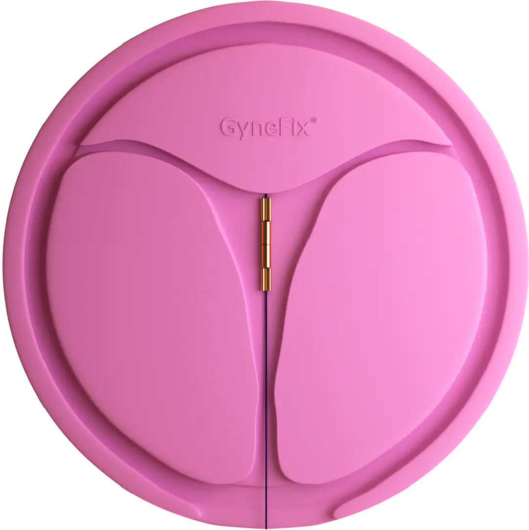 picture of gynefix in uterus