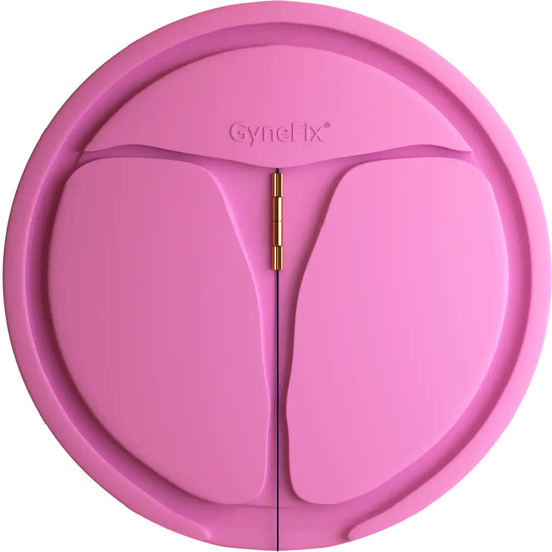 picture of gynefix in uterus